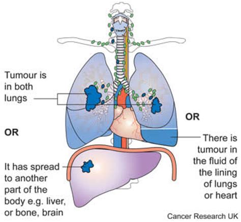 If your dog has a stroke, signs often appear suddenly, but may differ widely, depending on the area of the brain affected. How to Tell If Lung Cancer Has Spread to Brain?