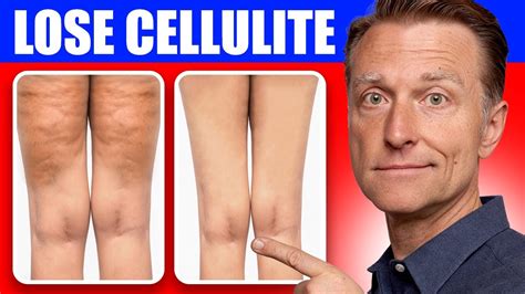 get rid of cellulite for good dr berg s better way to lose flabby fat youtube