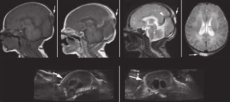 Atretic Parietal Encephalocele A C Sagittal T1 W Post Gd T1w T2w
