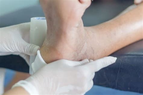 Diabetic Feet Pictures Diabetic Leg Ulcers Pictures Diabetic Blisters