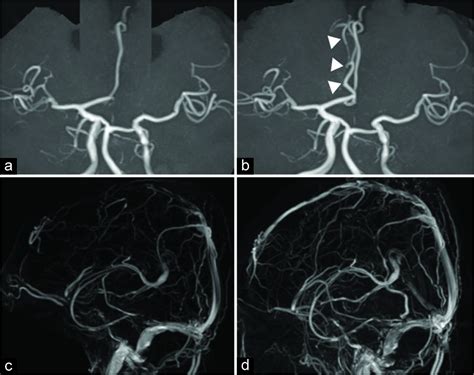 Cerebral venous thrombosis (cvt) refers to occlusion of venous channels in the cranial cavity, including dural venous thrombosis, cortical vein thrombosis and deep cerebral vein thrombosis. Reversible cerebral vasoconstriction syndrome concomitant ...