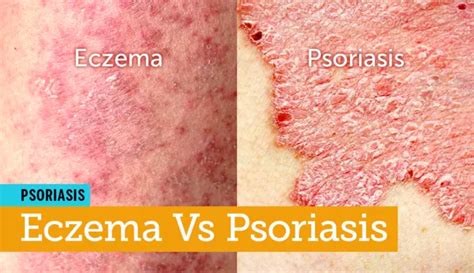 Eczema Vs Psoriasis Are They One And The Same Mypsoriasisteam