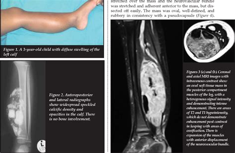 Pdf Leiomyoma Of The Calf Muscle In A Child With Calcification And