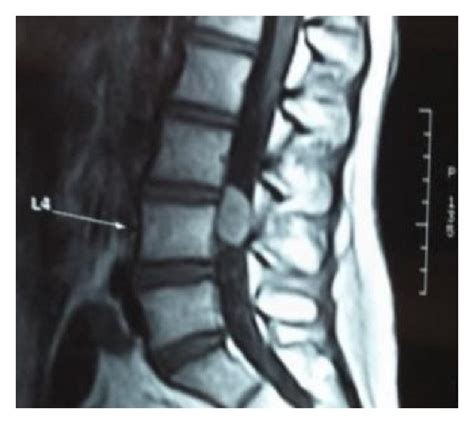 Mri Of The Lumbar Spine Showing A Hyperintense T1 Weighted Images A