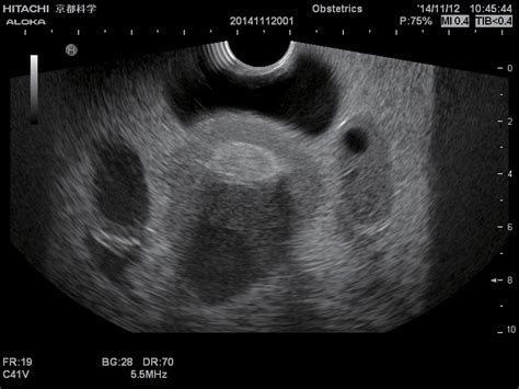 Normal Pelvic Ultrasound Female Pelvis And Perineum Radiology Key