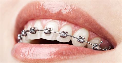 Aparelhos Dentarios Oralmedice