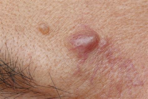 Cyst Lipoma Removal Skin Care Center