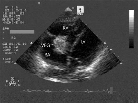 Endocarditis Cardiovascular Medbullets Step 1