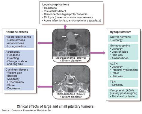 Clinical Effects Of Large And Small Pituitary Tumours Local Grepmed