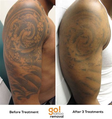 See more of fade fast laser tattoo removal on facebook. After 3 laser tattoo removal treatments there is ...