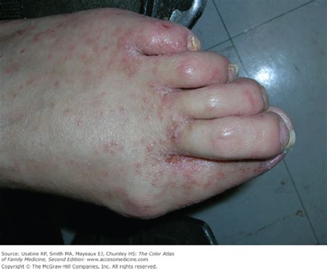 Scabies On Bottom Of Feet