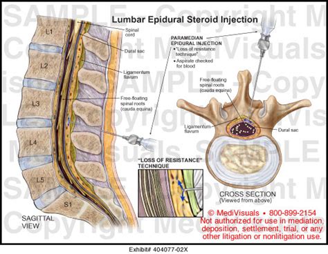 Lumbar Epidural Steroid Injection Medical Illustration