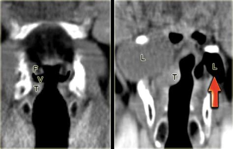 Left Coronal Ct Image Through The Larynx With Normal