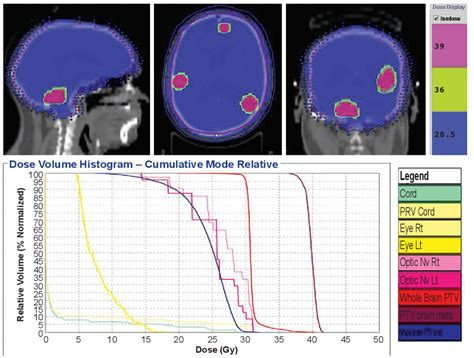 Figure 1 From Planning And Delivery Of Whole Brain Radiation Therapy