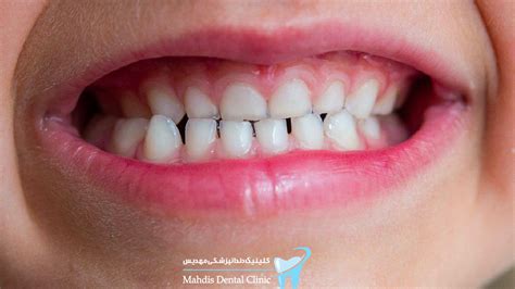درمان دندان قروچه در کودکان کلینیک دندانپزشکی شبانه روزی مهدیس