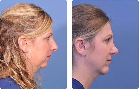 Chin Implant Before And After Real Patient Results