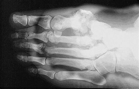 Clinical Radiograph Of Neuropathic Arthropathy Charcot Joint In A