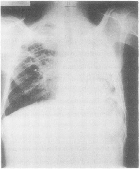 Chest Radiograph Ofpatient I At Presentation Showing Extensive