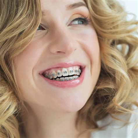 Debunking Common Myths About Getting Braces As An Adult