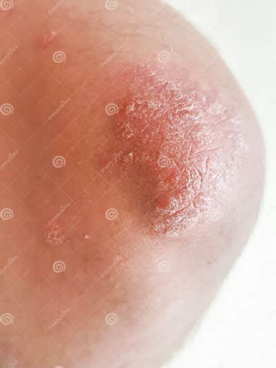 Elbow Skin Psoriasis Disease Problem Stock Photo Image Of Dermatitis