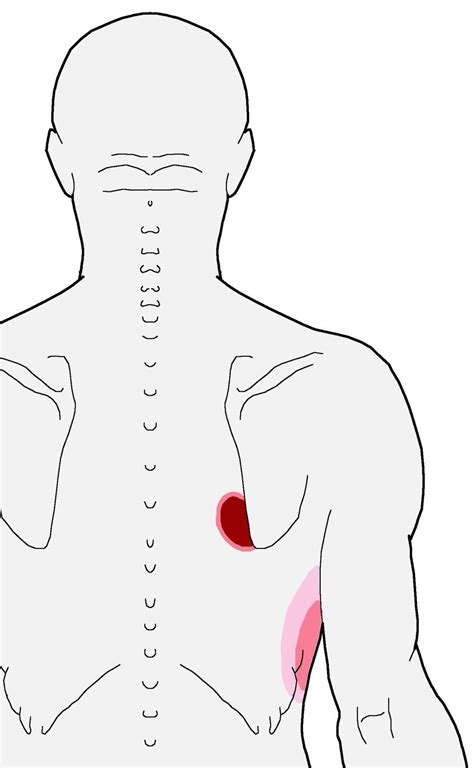 Trigger Points Nagging Pain Inside The Bottom Of The Shoulder