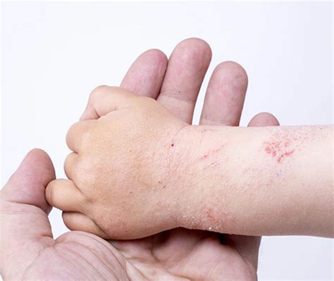 Цыпки на руках у детей причины симптомы лечение