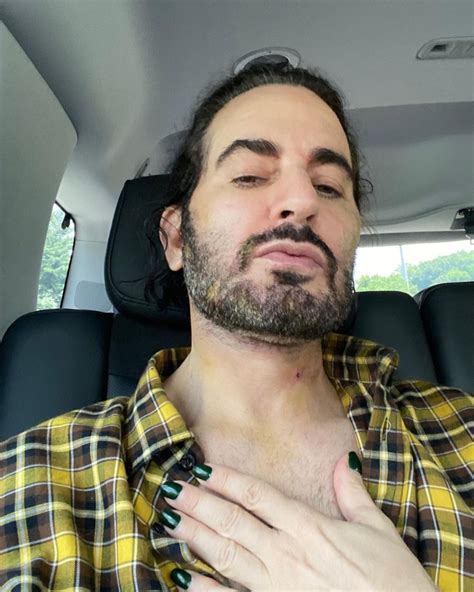 Marc Jacobs Shows Off Facelift Transformation 10 Days After Surgery