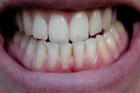 People who clench or grind their teeth (brux) during because you may have sleep bruxism and be unaware of it until complications develop, it's important to know the signs and symptoms of bruxism and to seek regular dental care. How To Stop Grinding Teeth Whilst Sleeping? Night Guards ...