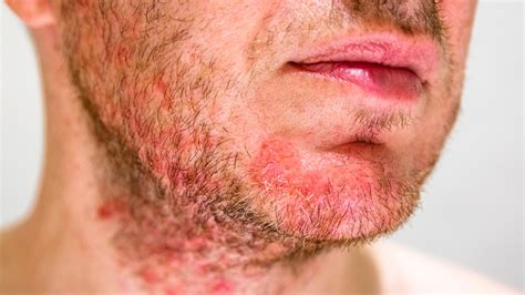 The Best Way To Get Rid Of Folliculitis