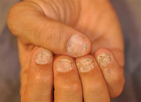 Nail Dystrophy Definition Causes And Treatment