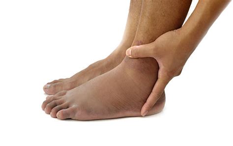 Swollen Ankles Stock Photos Pictures And Royalty Free Images Istock