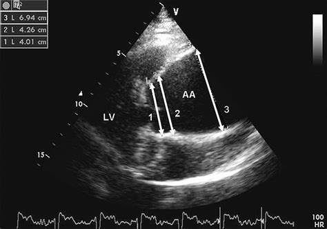 Thoracic Aortic Aneurysm Echocardiogram
