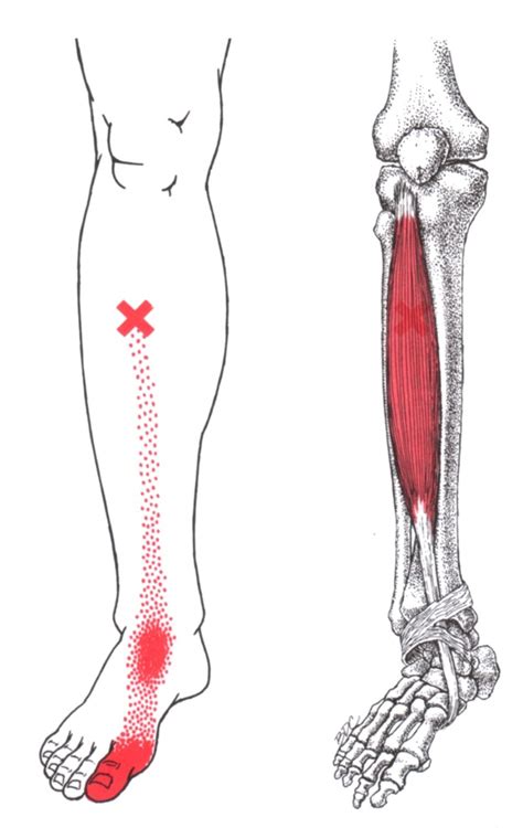 Tibialis Anterior The Trigger Point And Referred Pain Guide
