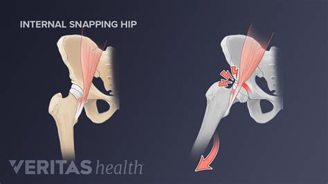 3 Types Of Snapping Hip Syndrome Sports Health