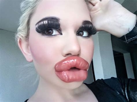 instagram viral mujer se inyecta 20 veces en los labios buscando tener los labios más grandes