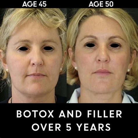 Discover The Secret To A Natural Look With Dermal Filler