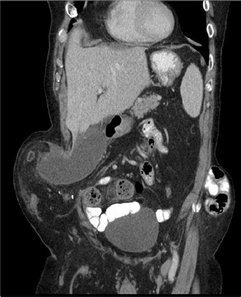 Ct From Current Admission With Distended Gallbladder Consistent With