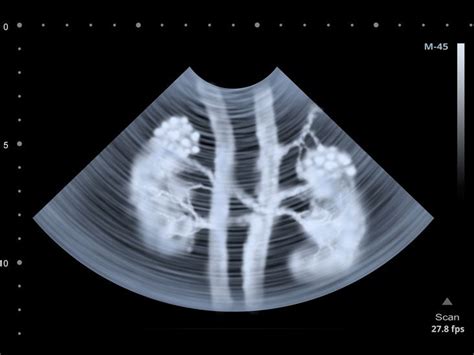 Clear Insights Understanding Kidney Health Through Ultrasound Scans