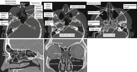 Of The Paranasal Sinuses Radiology Key
