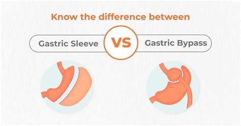Know The Difference Between Gastric Sleeve Vs Gastric Bypass In 2022 Gastric Bypass Gastric