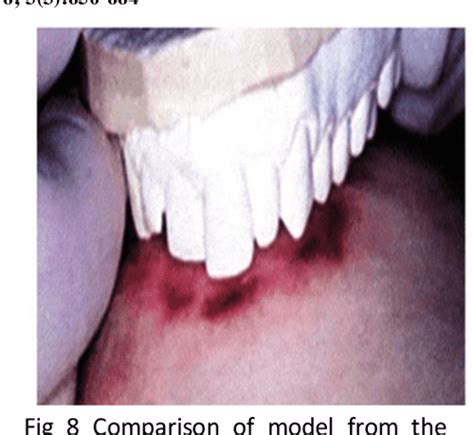 Bite Mark Analysis In Forensic Odontology Semantic Scholar