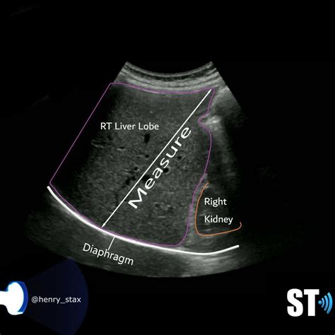 Liver Anatomy And Protocol Basics Sonographic Tendencies In 2021
