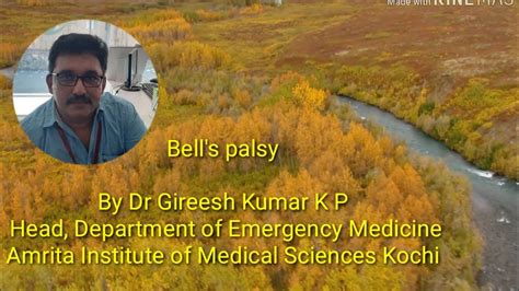 Bells Palsy By Dr Gireesh Kumar K P Youtube