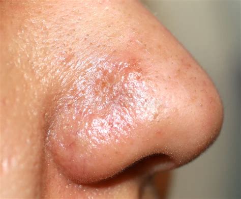 Pimple Inflamado En La Nariz Cyst Acne Acn En La Piel Foto De Archivo