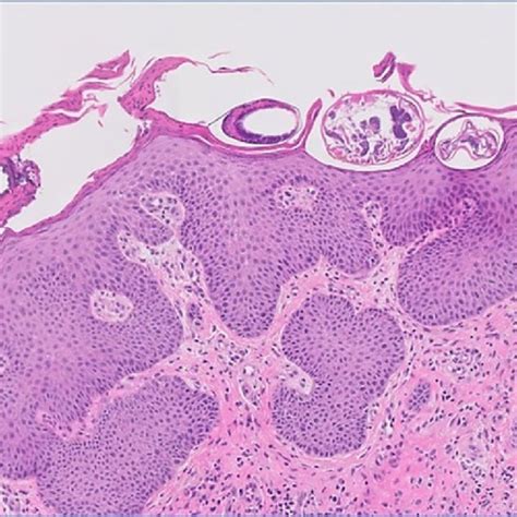 Histopathology Of Scabies Showing Multiple Mites And Irregular