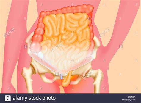 Inguinal Hernia Hi Res Stock Photography And Images Alamy