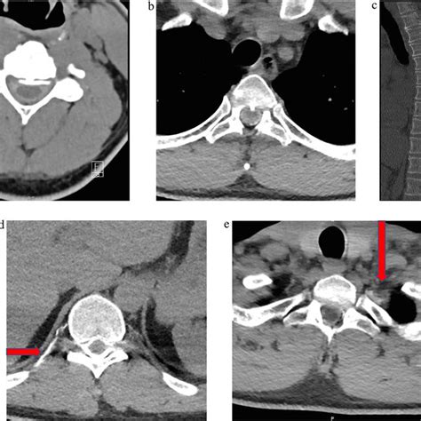 A Axial Ct Image Of The Cervical Spine Post Myelography Depicts