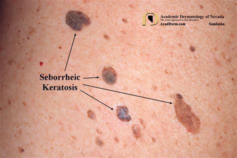 Seborrheic Keratosis Skin Lesions