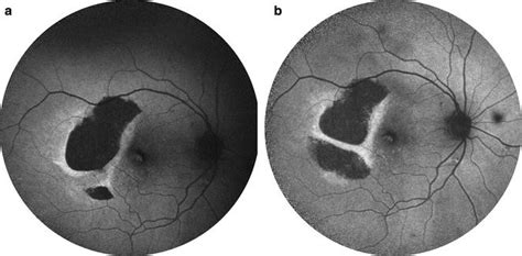 Clinical Applications Of Fundus Autofluorescence In Retinal Disease