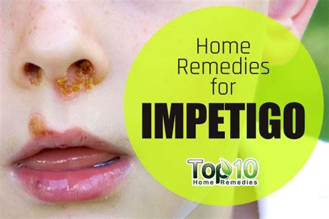 Home Remedies For Impetigo Top 10 Home Remedies